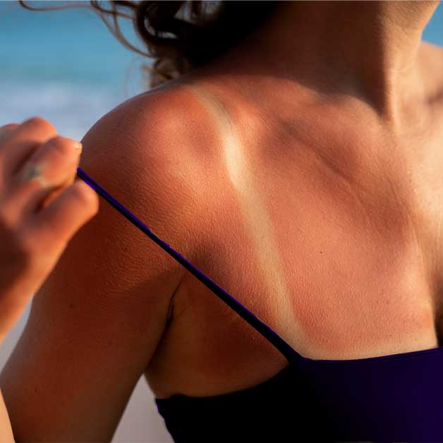 comment-prevenir-et-traiter-les-coups-de-soleil-et-les-insolations