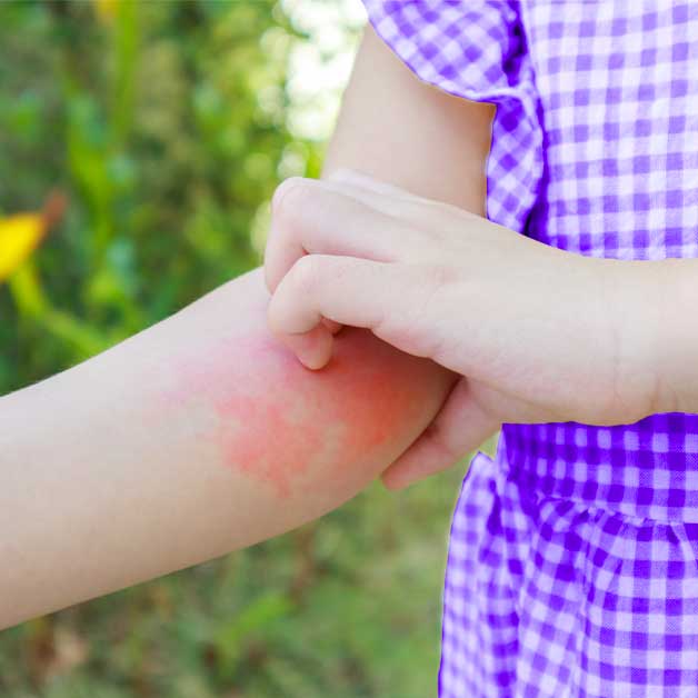 les-dangers-des-piqures-d-insectes-en-ete-et-comment-s-en-proteger